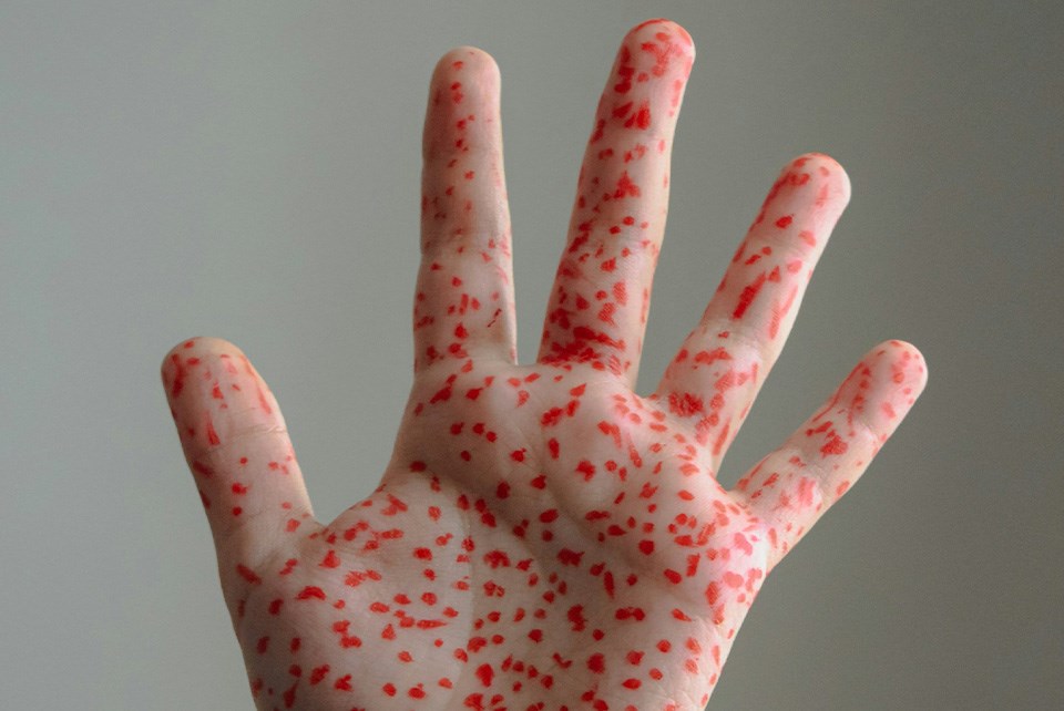 Measles Outbreak: Saskatoon Schools & Baseball